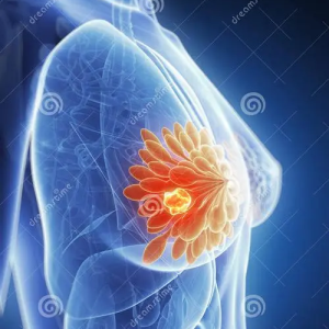 阿貝西利治療晚期乳腺癌效果數據及不良反應解讀