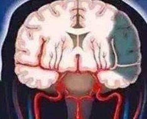 身體發出這6個“信號”，可能是頭部血管堵塞 千萬別大意！