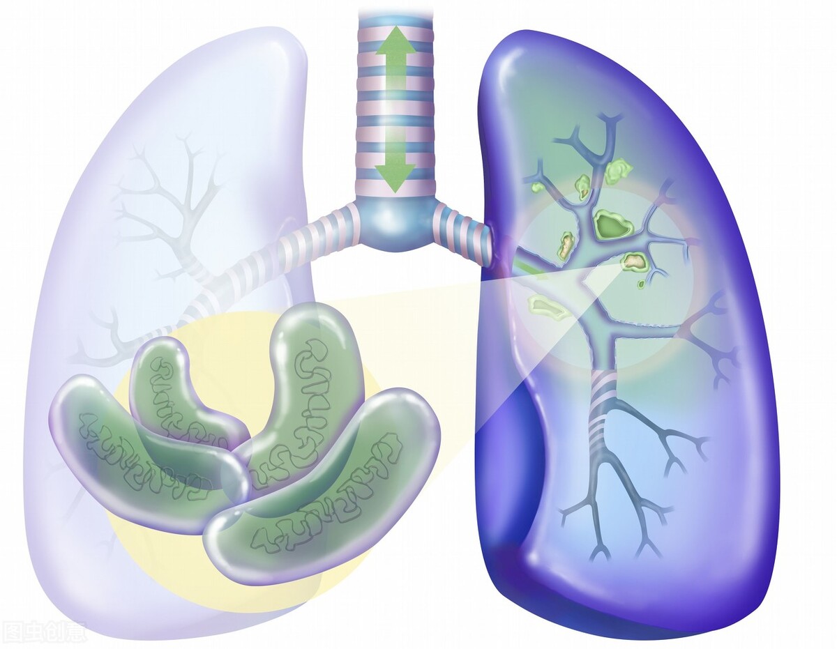 初期肺結核有哪些症狀 肺結核如何傳染